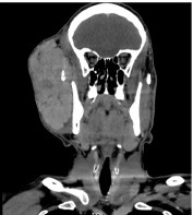 Hybrid Tumor of the Parotid Gland CT scan
