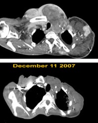 DFSP CT scan December 2007