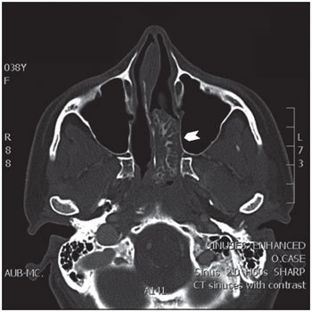 CT scan COREAH nasal cavity
