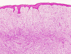 DFSP histological section showing subcutaneous tissue involvement