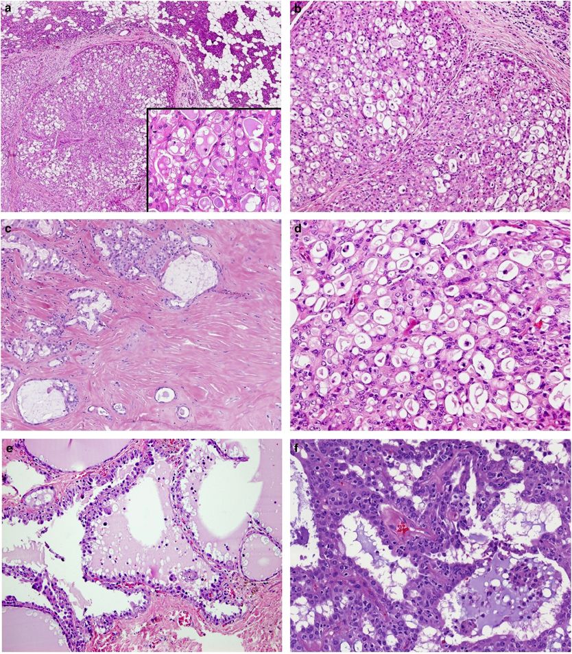 Histological sections of the hybrid parotid tumor