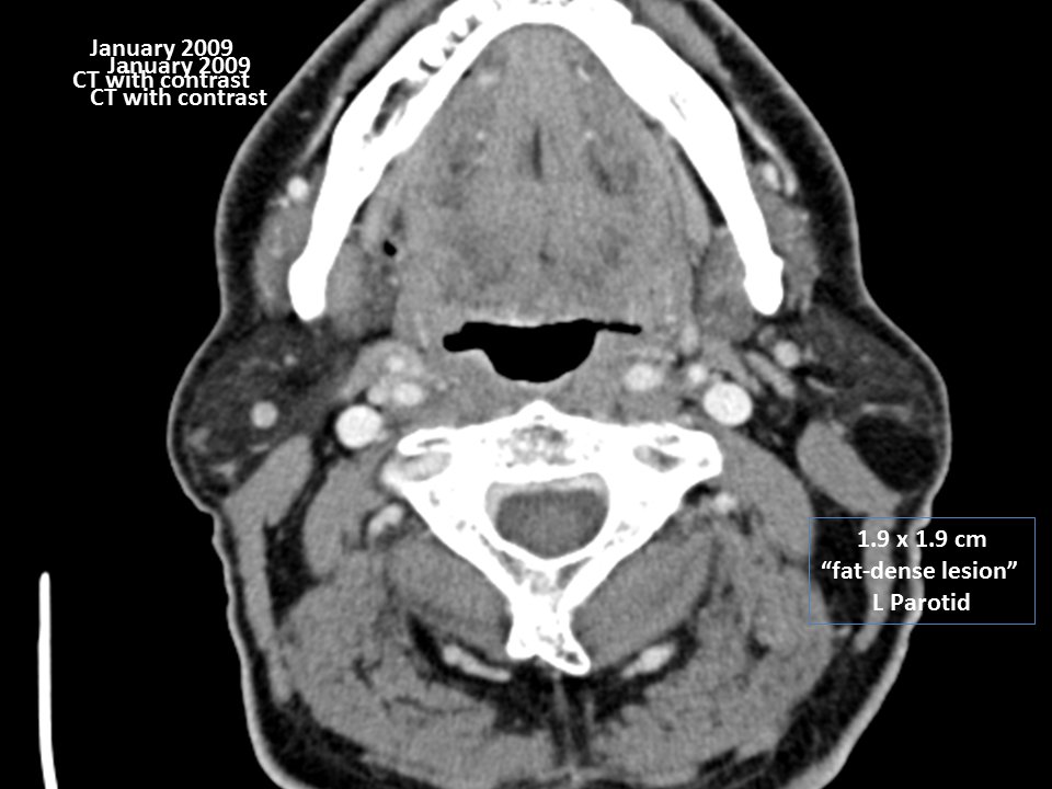 CT scan lipomatous lesion parotid gland