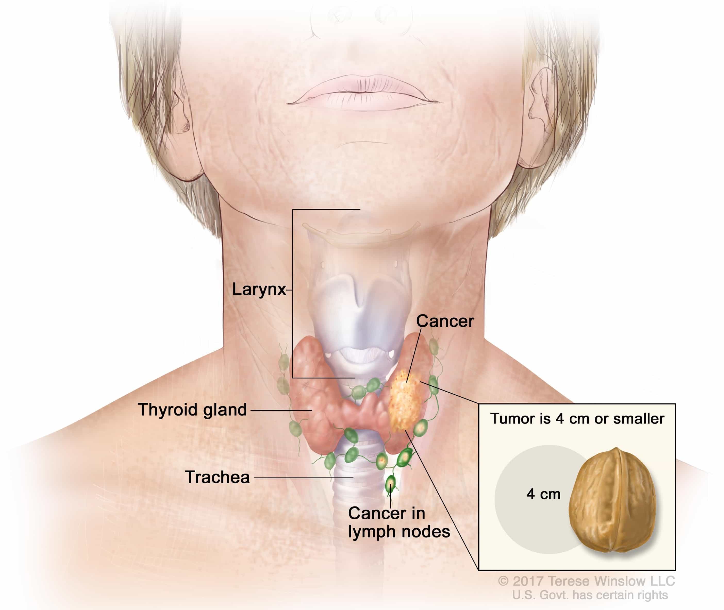 Thyroid cancer anatomy illustration