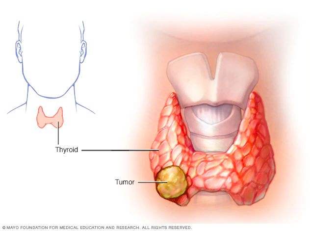 Thyroid tumor anatomy diagram